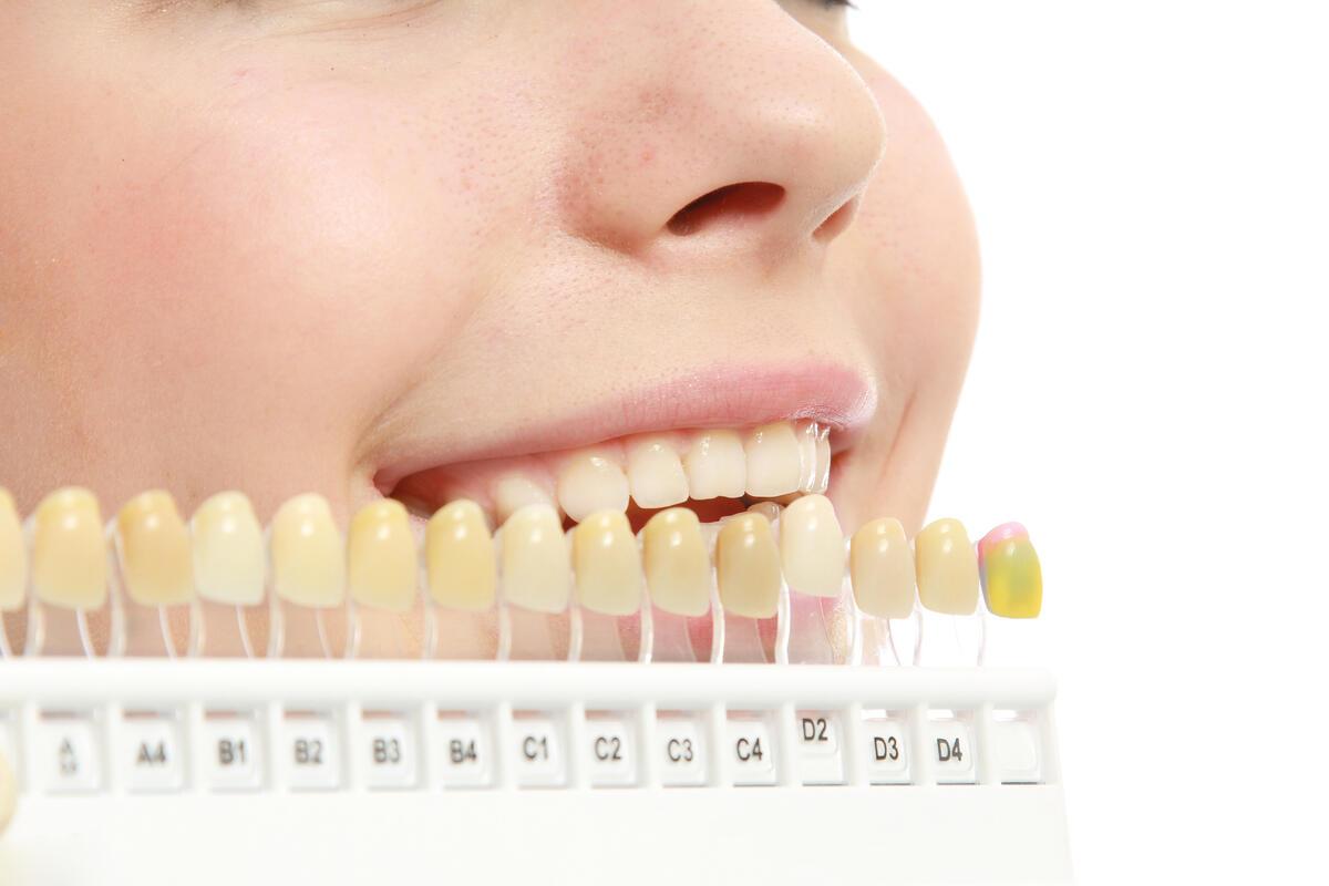 Elszíneződések kezelése - Elszíneződött fogak kezelése esztétikai fogászatunkon! Az elszíneződés oka lehet a kávé, tea, kóla, vörösbor rendszeres fogyasztása és a dohányzás.
