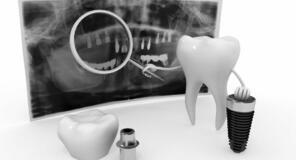 Fogbeültetés implantátummal I Móricz Dental Fogászat