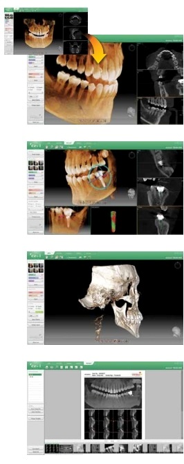 3D fogászati CT tervézése