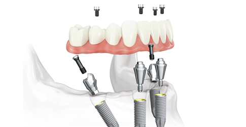 Implant-supported fixed dental prostheses