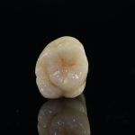 Cirkon korona - Móricz Dental Esztétikai Fogászat