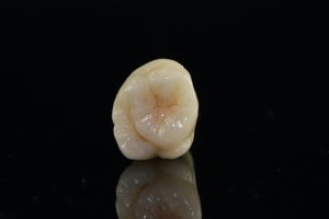 Cirkon korona - Móricz Dental Esztétikai Fogászat