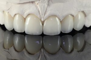 Cirkon koronák ragasztás előtt - Móricz Dental Fogászat
