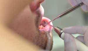 Dentálhigiénia, fogkőleszedés, polírozás - Móricz Dental Fogászat