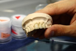 Fémkerámia koronák - Móricz Dental Fogászat