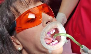 Irányított biofilm terápia: a lepedék láthatóvá tétele - Móricz Dental