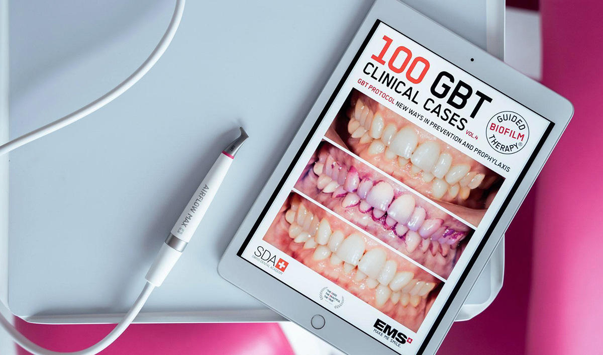 Irányított biofilm terápia előtte-utána - Móricz Dental Fogászat
