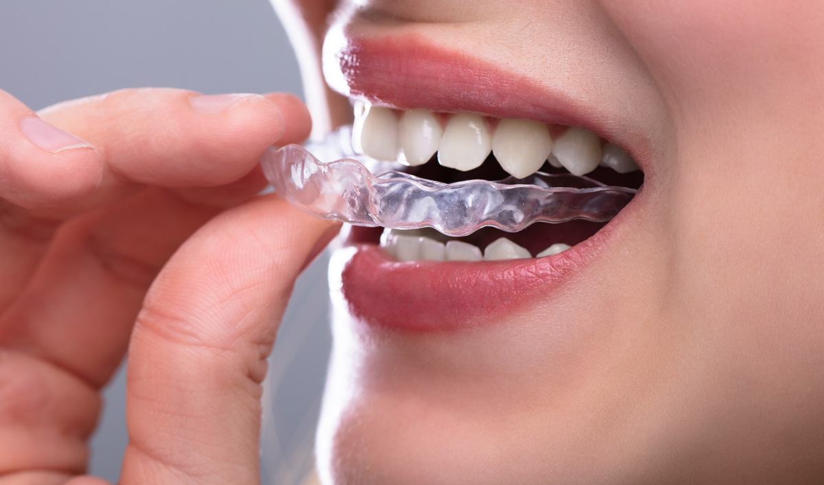 Otthoni fogfehérítő sín - Móricz Dental Fogászat