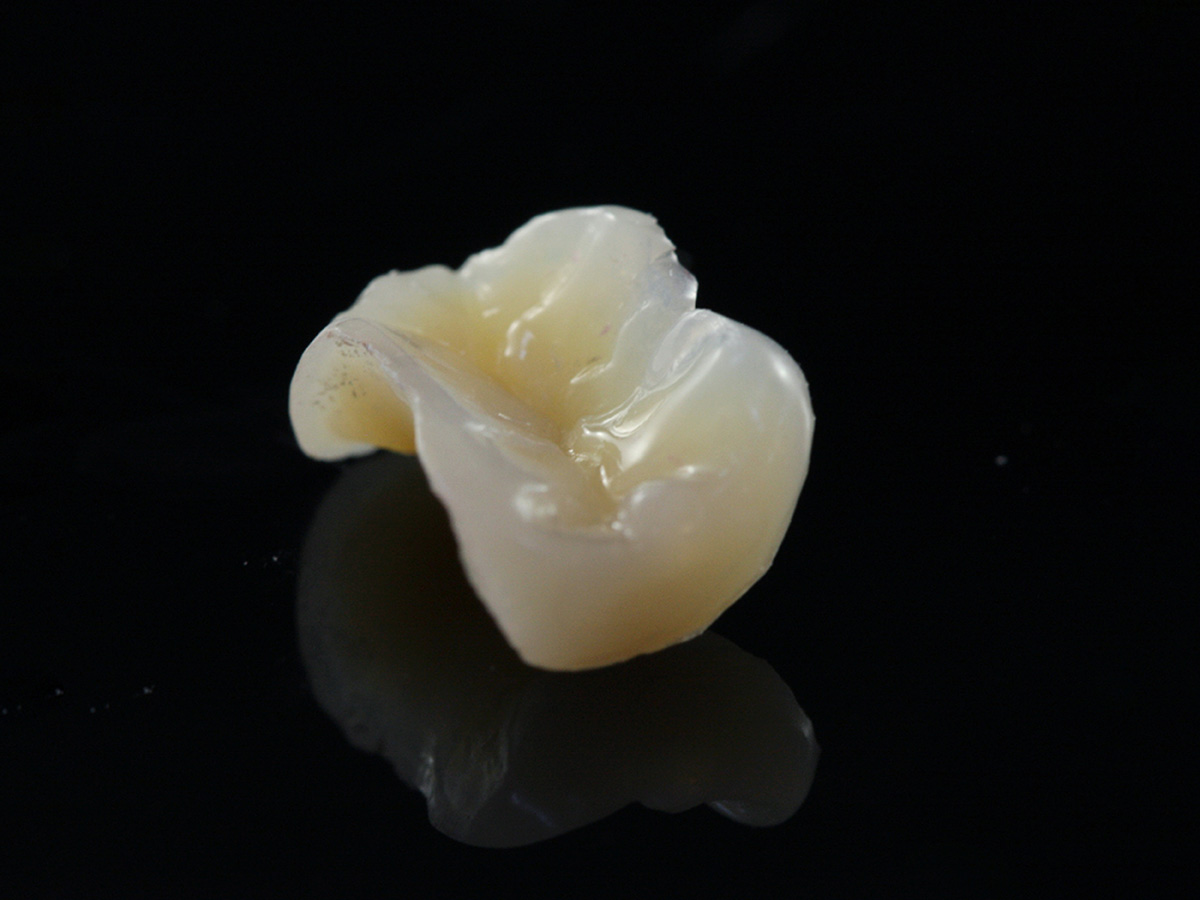 Szuper esztétikus betét (inlay/onlay)